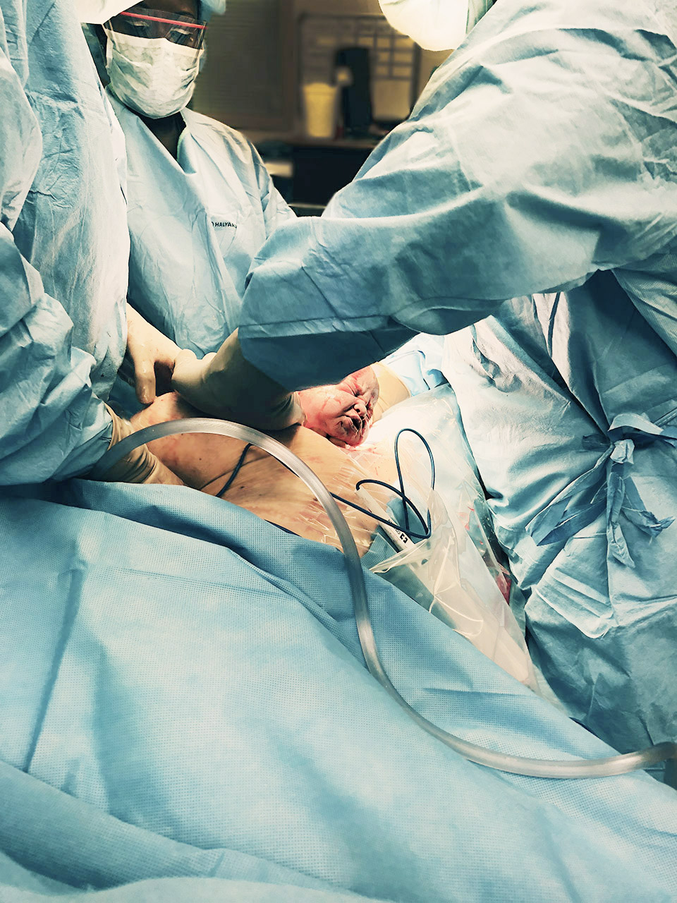 What It's Really Like to Have a C Section - 30A Mama