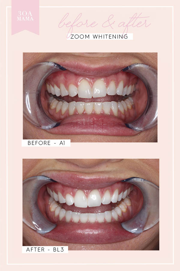 30A Mama Destin Center for Cosmetic Dentistry Zoom before and after